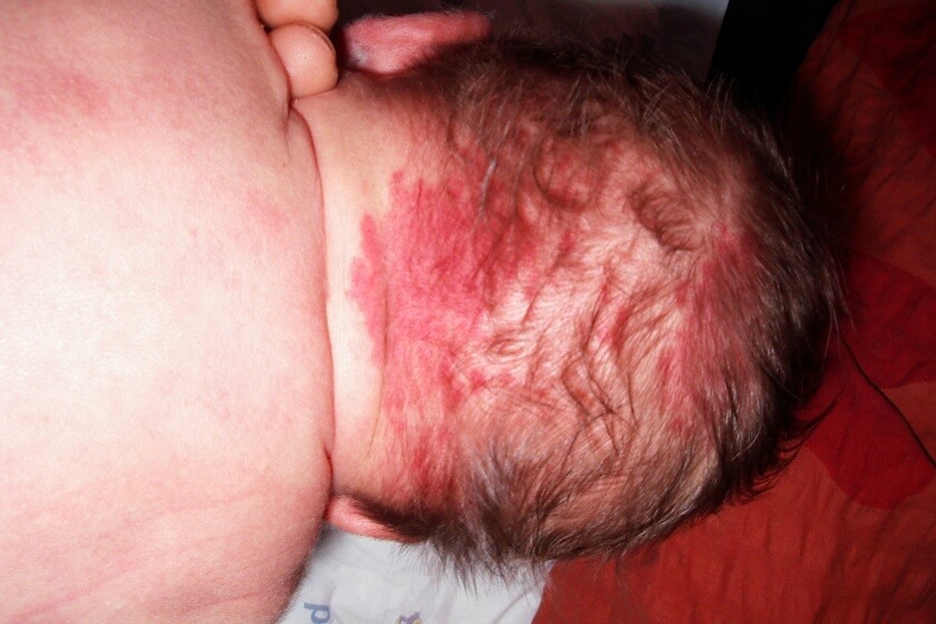 Baby mit Storchenbiss Neugeborenes mit Storchenbiss am Hinterkopf
